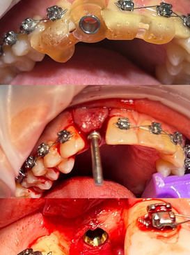 Slider image (3) Proesthetic Dental Care in Los Algodones, Mexico